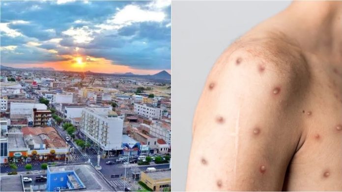 Secretário de Saúde comenta caso confirmado de varíola dos macacos em Patos e diz que paciente está bem. OUÇA